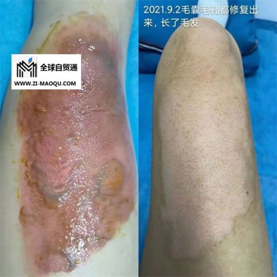 乐巴康-荔湾区皮肤疤痕美容修复技术加盟